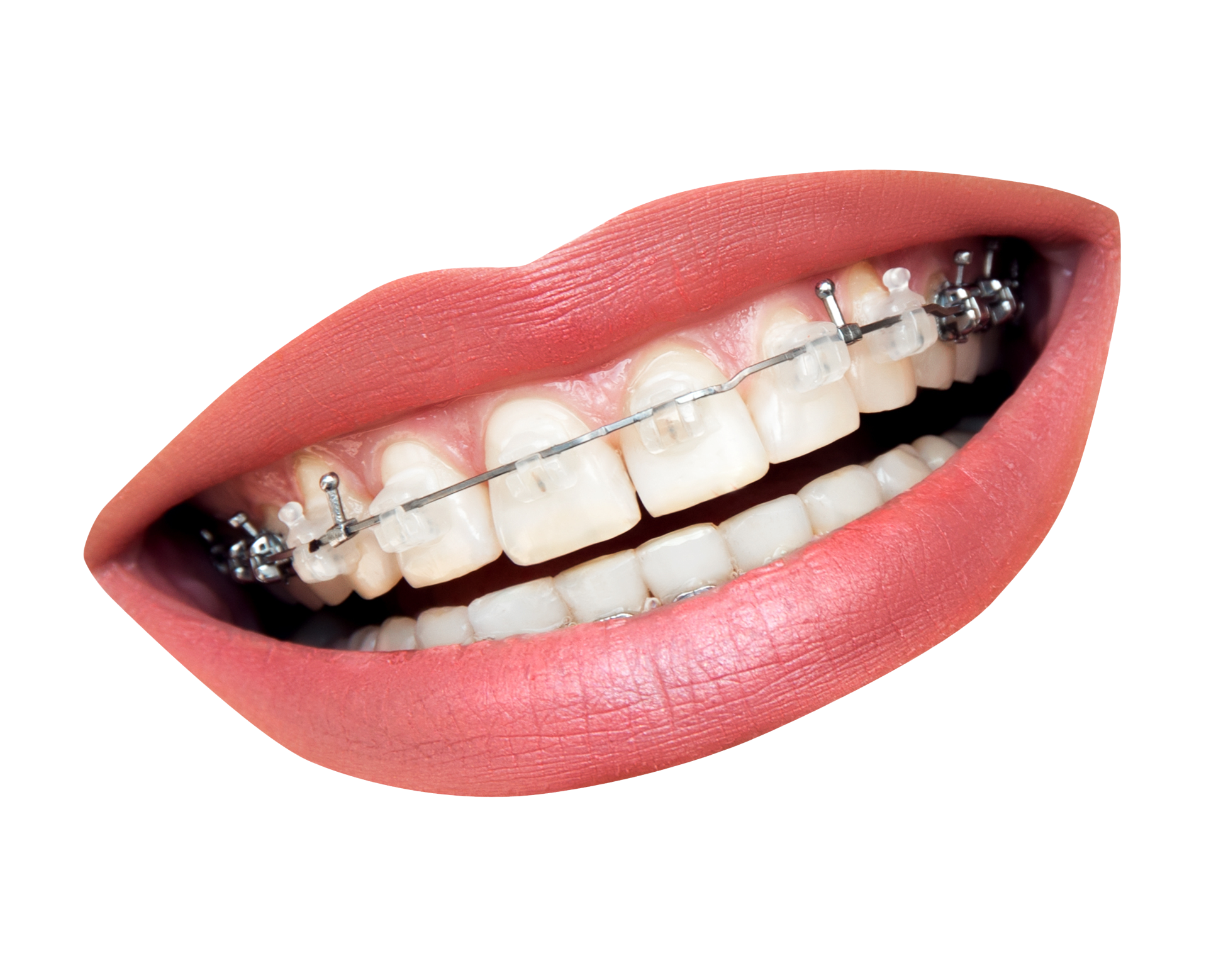 kisspng-dental-braces-dentistry-orthodontics-tooth-clear-a-teeth-with-braces-5a72963b44a719.5935776215174590032812